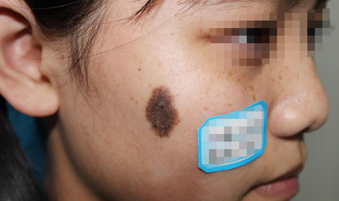 �Ϻ���̥�ǽ���ɸ��